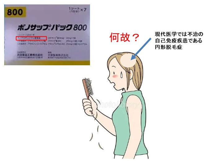 円形脱毛症　病院